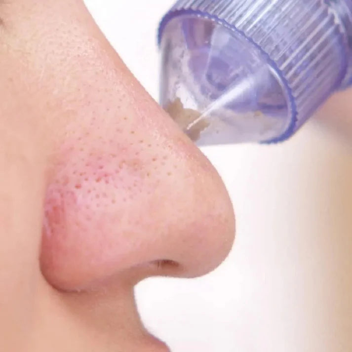 4 In 1 Portable Blackhead Derma Suction Device